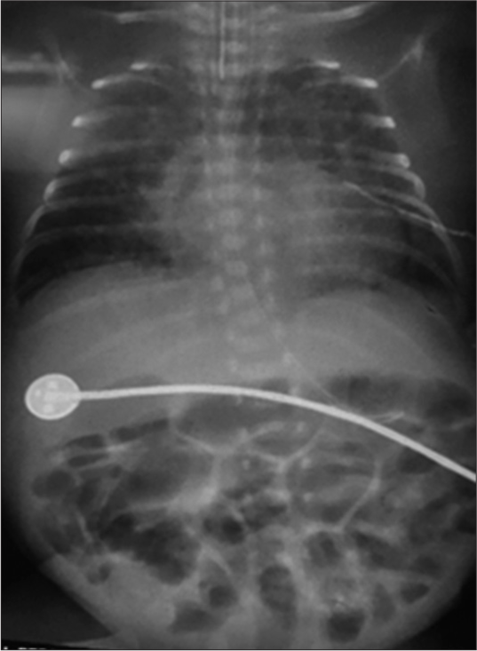 X-ray chest-abdomen of the neonate showing hazy opaque lungs, diffuse interstitial thickening as result of bronchopulmonary dysplasia, cardiomegaly, and pulmonary plethora due to patent ductus arteriosus, generalized distension of intestinal loops as a feature of necrotizing enterocolitis.