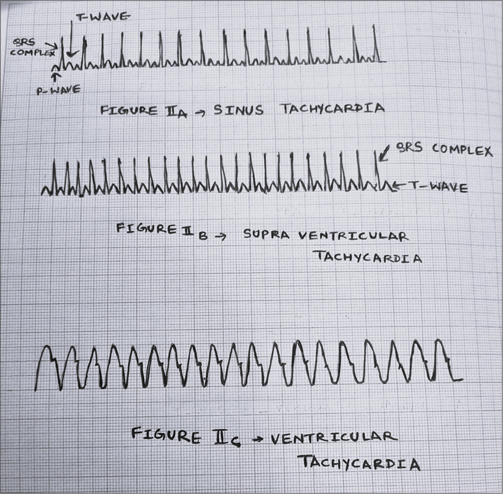 Tachyarrhythmia.