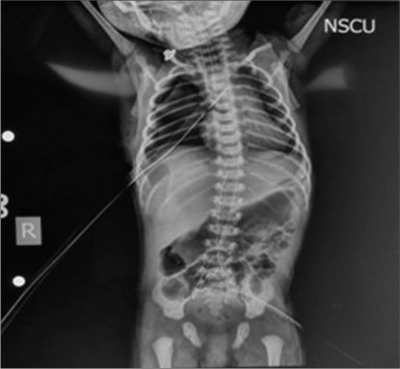 Post-operative chest x-ray showing endotracheal tube, nasogastric going into the stomach, and intercostal drain (ICD) in situ.